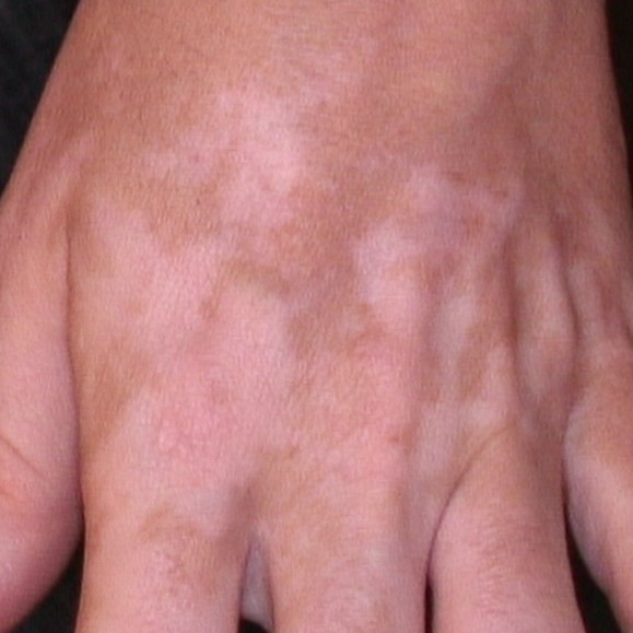 Karboksiterapian ja kapeakaistaisen ultravioletti B:n yhdistelmä vitiligon vastahakoisten alueiden hoidossa: satunnaistettu kliininen tutkimus