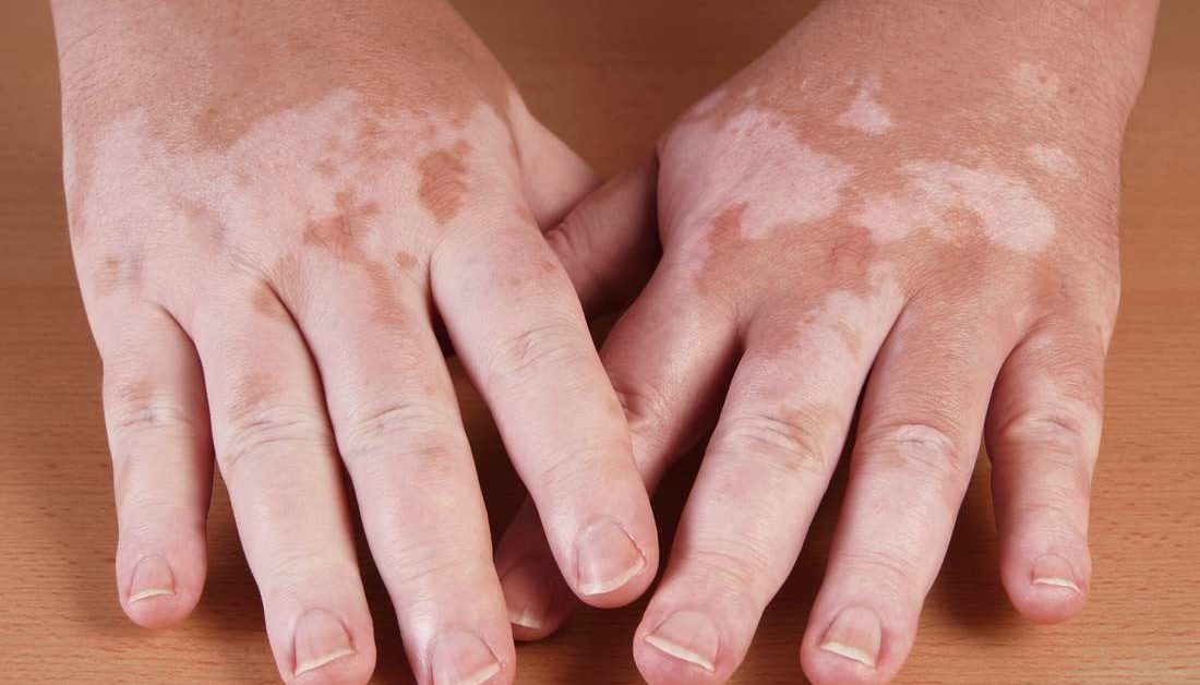 Tämän systemaattisen katsauksen ja meta-analyysin tulokset viittaavat siihen, että UV-valohoito on turvallinen hoito vitiligoon ilman merkittävää ihosyövän riskiä.